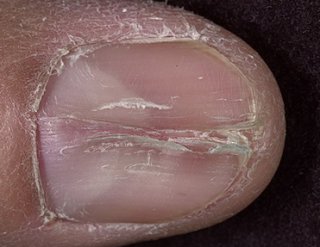 Диагностика заболеваний внутренних органов по состоянию ногтей