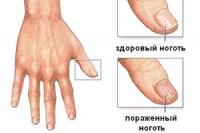 Лечение грибковых инфекций ногтей и кожи: от чего зависит успех?